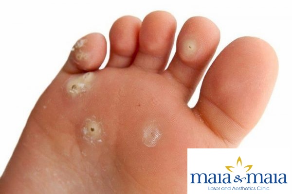 Hạt cơm- mụn cóc lòng bàn chân Phòng khám chuyên khoa da liễu Maia Hạt cơm- mụn cóc lòng bàn chân