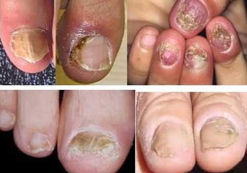 Bệnh vảy nến móng gây mất thẩm mỹ Bệnh vảy nến móng gây mất thẩm mỹ