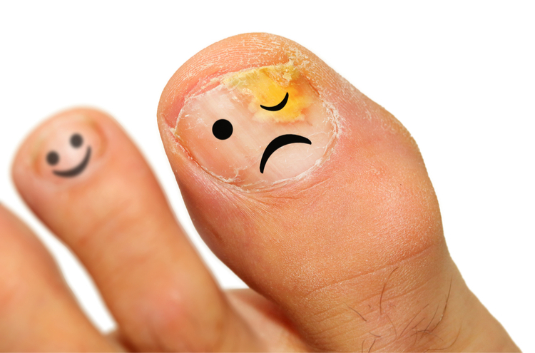 Bệnh vảy nến móng chân Bệnh vảy nến móng chân