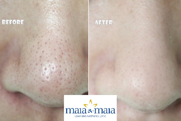 Hình ảnh thu nhỏ lỗ chân lông tại Pk chuyên khoa Da liễu Maia&Maia Hình ảnh thu nhỏ lỗ chân lông
