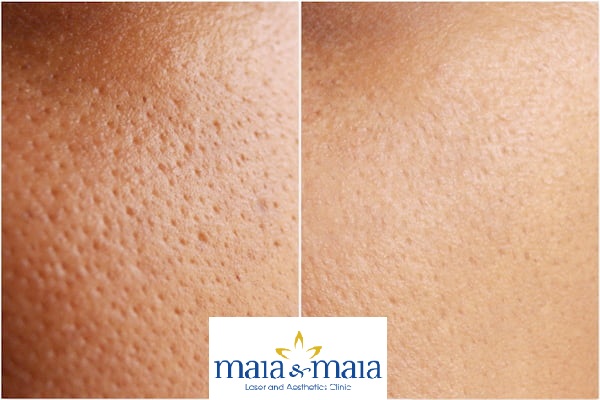 Hình ảnh trước và sau khi thu nhỏ lỗ chân lông bằng Công nghệ Hellos III tại PK Maia&Maia Hình ảnh trước và sau khi thu nhỏ lỗ chân lông
