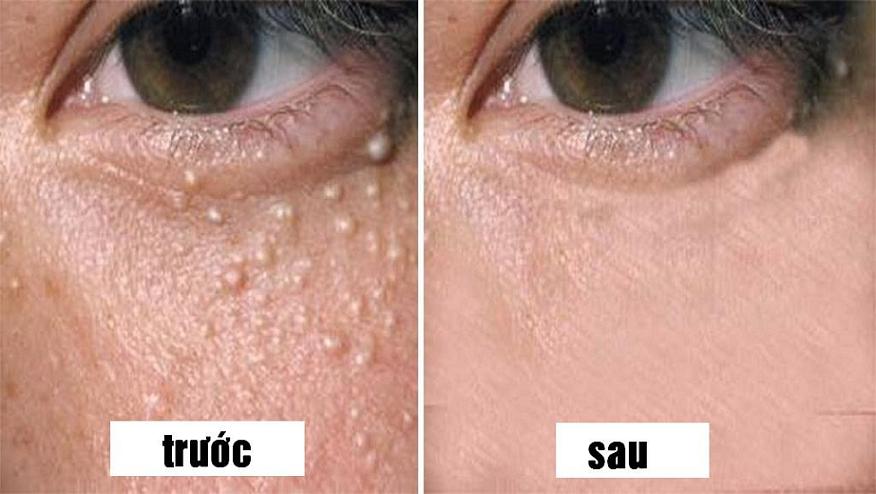 Hiệu quả sau khi điều trị mụn thịt Hiệu quả sau khi điều trị mụn thịt