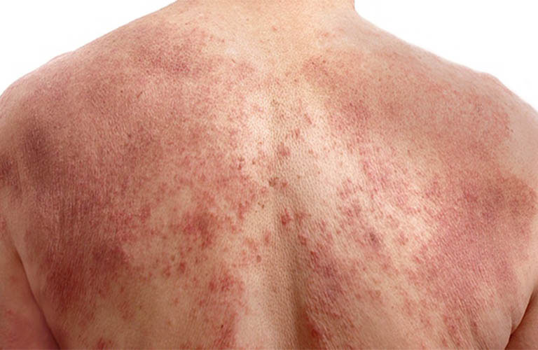 Bệnh viêm da cơ địa Bệnh viêm da cơ địa