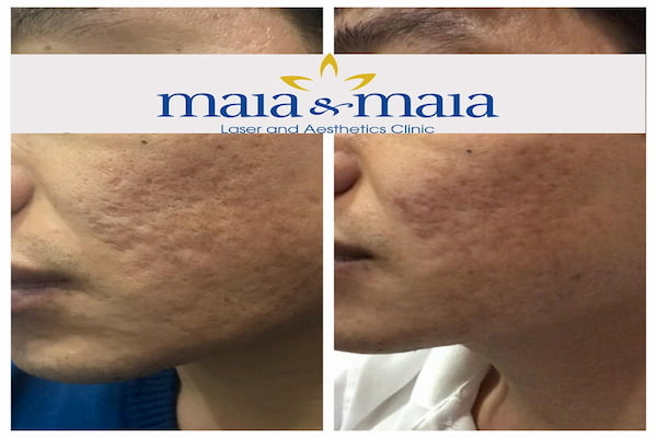Hình ảnh : Trước và sau khi điều trị sẹo lõm bằng công nghệ Laser Mixel Ảnh trước sau
