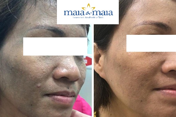 Kết quả điều trị nám trước - sau (ảnh thật 100%) Kết quả điều trị nám trước - sau (ảnh thật 100%)