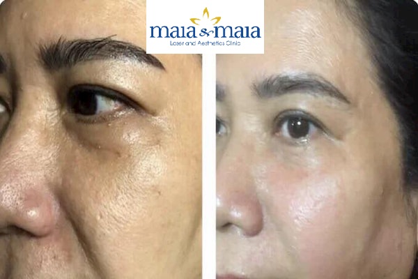 Hình ảnh: Khách hàng trước và sau khi hỗ trợ căng da bằng công nghệ Thermage Hình ảnh: Khách hàng trước và sau khi hỗ trợ căng da bằng công nghệ Thermage