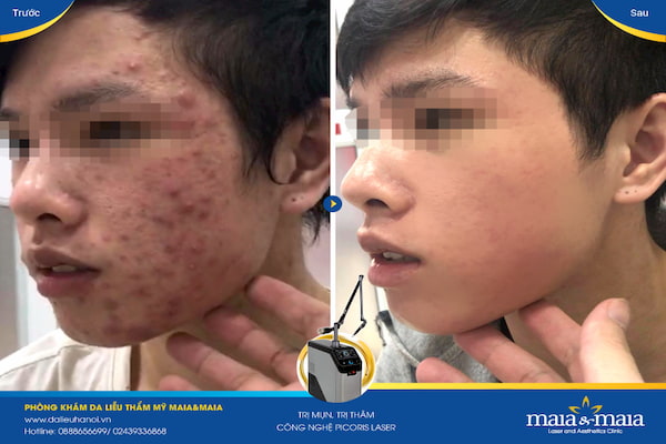 Hình ảnh: Sau khi hỗ trợ điều trị lấy nhân mụn bằng phương pháp Laser DIOT Hình ảnh: Sau khi hỗ trợ điều trị lấy nhân mụn bằng phương pháp Laser DIOT