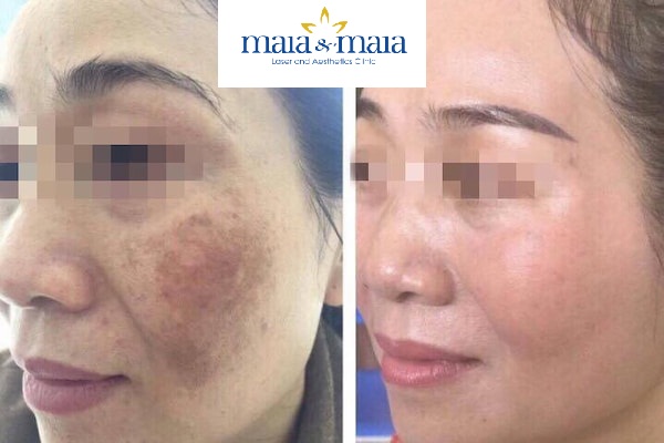 Kết quả điều trị nám trước - sau (ảnh thật 100%) Kết quả điều trị nám trước - sau (ảnh thật 100%)
