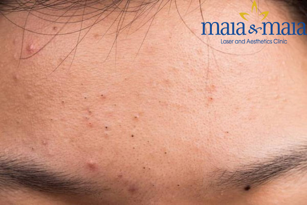 Hình ảnh : Mụn đầu đen Hình ảnh : Mụn đầu đen