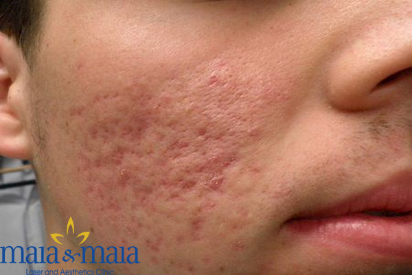 Hình ảnh : Sẹo rỗ xấu xí để lại trên da do điều trị mụn sai cách