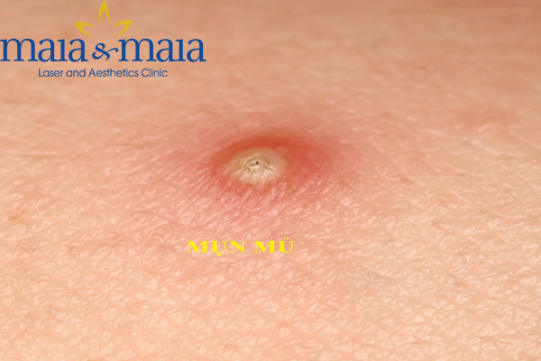 Hình ảnh : Mụn mủ gây đau nhức, khó chịu