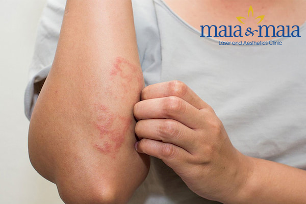 Hình ảnh: Viêm da tiếp xúc dị ứng