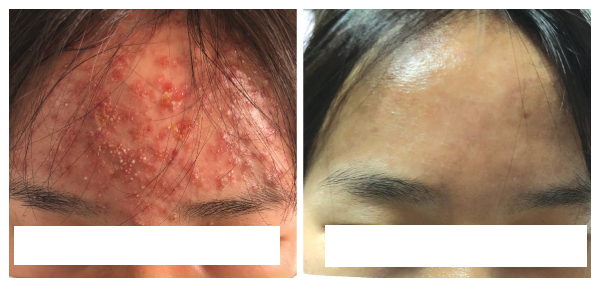 Hình ảnh: Trước và sau khi hỗ trợ điều trị sẹo thâm do mụn Hình ảnh: Trước và sau khi hỗ trợ điều trị sẹo thâm do mụn