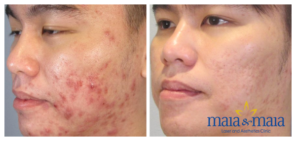 Hình ảnh: Khách hàng trước - sau khi hỗ trợ điều trị sẹo thâm do mụn Hình ảnh: Khách hàng trước - sau khi hỗ trợ điều trị sẹo thâm do mụn