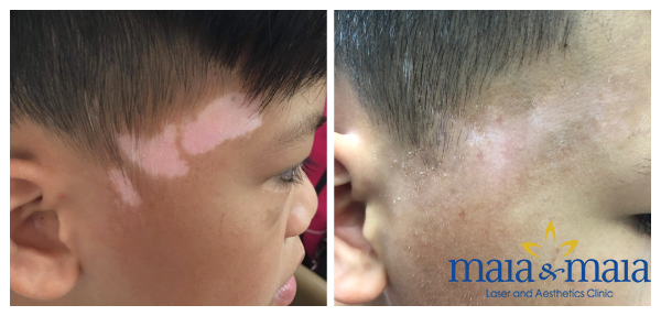 Hình ảnh: Trước và sau khi hỗ trợ điều trị bạch biến