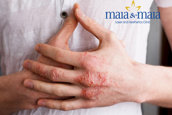 Hình ảnh: Bệnh viêm da tiếp xúc gây ảnh hưởng đến cuộc sống