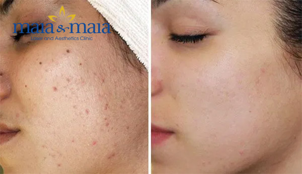Sản phẩm chuyên dụng khiến vết thâm đáng ghét nhanh chóng biến mất hơn Sản phẩm chuyên dụng khiến vết thâm đáng ghét nhanh chóng biến mất hơn