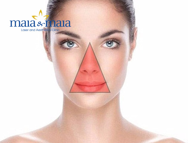 Nặn mụn vùng tam giác cấm có thể gây tử vong Nặn mụn vùng tam giác cấm có thể gây tử vong