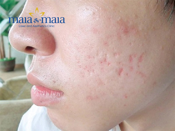 Nặn mụn có thể để lại seo trên da Nặn mụn có thể để lại seo trên da