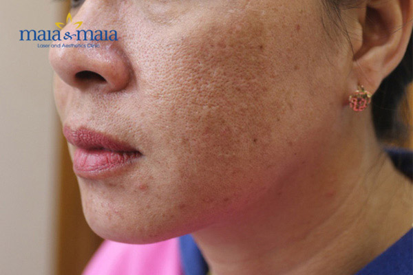 Vết nám bị đen lên sau khi hỗ trợ điều trị Vết nám bị đen lên sau khi hỗ trợ điều trị