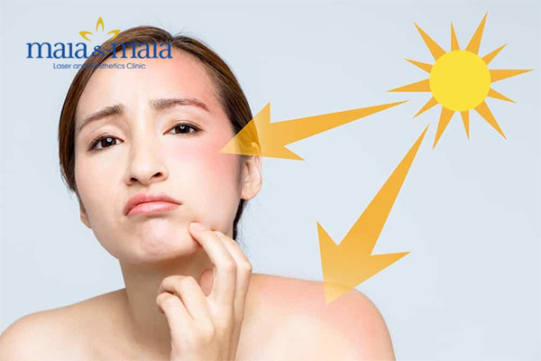 Tiếp xúc với ánh nắng mặt trời có thể gây nám da Tiếp xúc với ánh nắng mặt trời có thể gây nám da