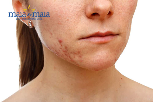 Sẹo thâm mụn Sẹo thâm mụn