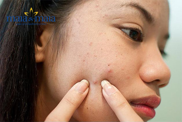 Nặn mụn không đúng cách gây viêm nhiễm nặng Nặn mụn không đúng cách gây viêm nhiễm nặng