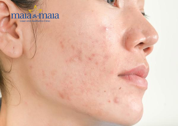Vết thâm sau mụn Vết thâm sau mụn