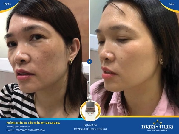 Hiệu quả sau điều trị nám, tàn nhang tại PK Maia Hiệu quả sau điều trị nám, tàn nhang tại PK Maia