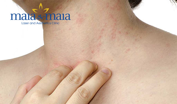 Mụn trứng cá mọc ở cổ Mụn trứng cá mọc ở cổ