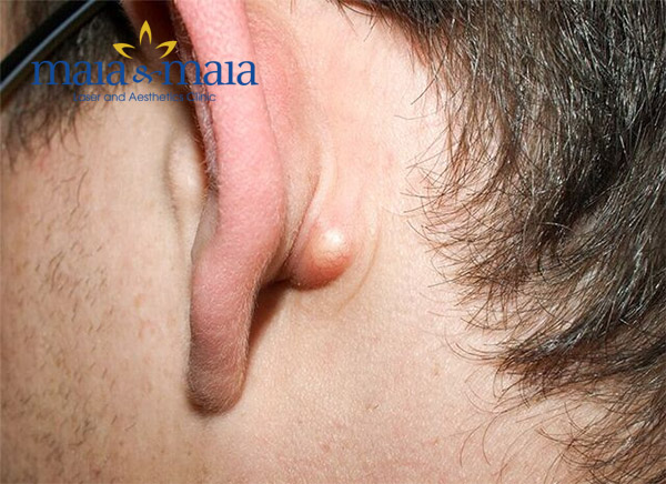 Mụn trứng cá mọc ở tai Mụn trứng cá mọc ở tai