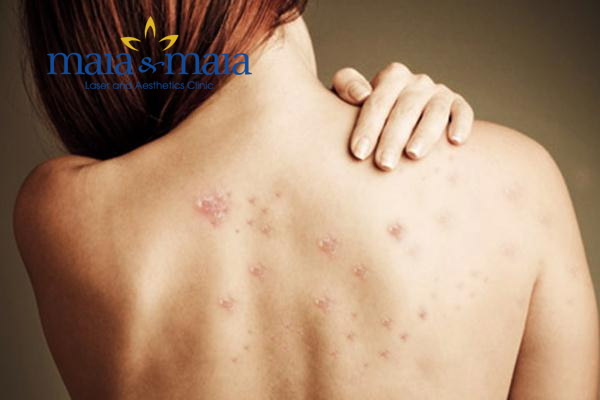 Mụn trứng cá sau lưng Mụn trứng cá sau lưng