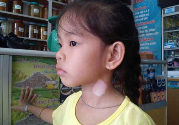 Bạch biến ở cổ Bạch biến ở cổ