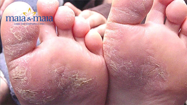 Bệnh á sừng ở chân Bệnh á sừng ở chân