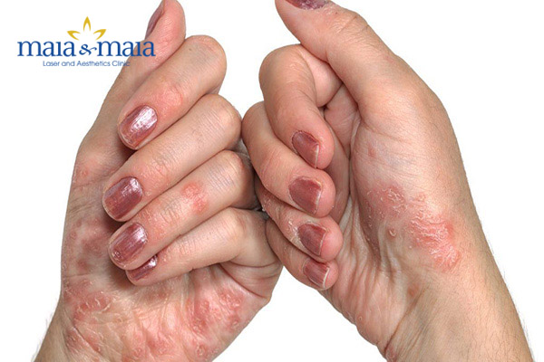 Bệnh á sừng hoàn toàn có thể điều trị được Bệnh á sừng hoàn toàn có thể điều trị được