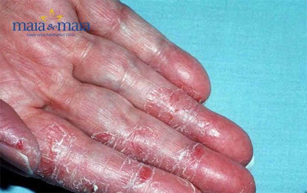 Bệnh á sừng ở tay Bệnh á sừng ở tay
