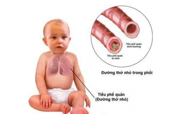Viêm tiểu phế quản Viêm tiểu phế quản