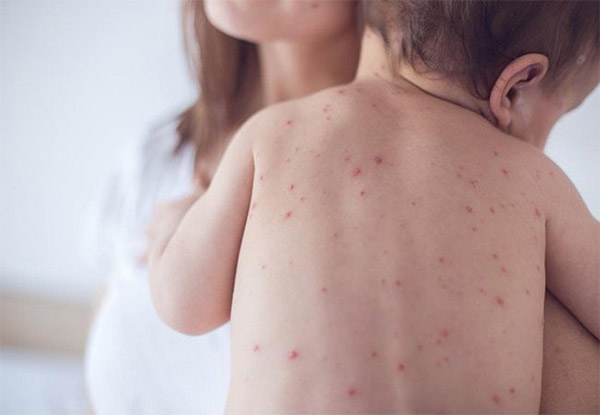 Sốt phát ban Sốt phát ban