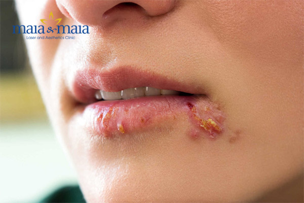 Bệnh herpes ở môi Bệnh herpes ở môi