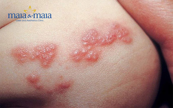 Bệnh herpes ảnh hương rất nhiều tới sức khỏe Bệnh herpes ảnh hương rất nhiều tới sức khỏe