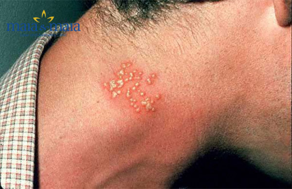 Bệnh Herpes trên cổ Bệnh Herpes trên cổ