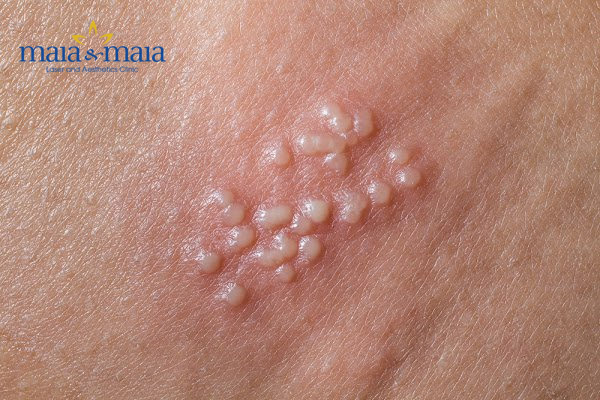 Hình ảnh bệnh herpes Hình ảnh bệnh herpes