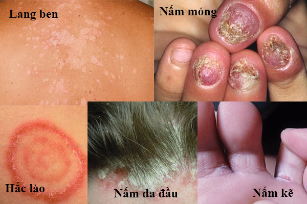 Các bệnh nấm da thường gặp Các bệnh nấm da thường gặp