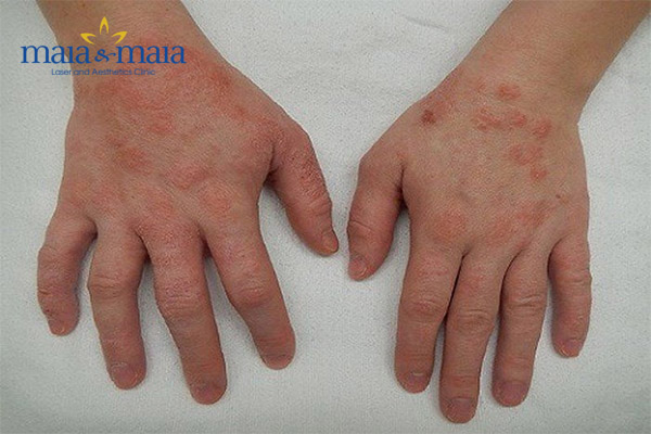 Bệnh viêm da cơ địa Bệnh viêm da cơ địa