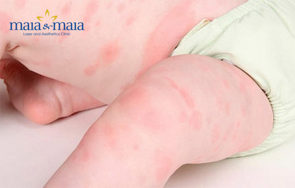 Bệnh nổi mề đay Bệnh nổi mề đay