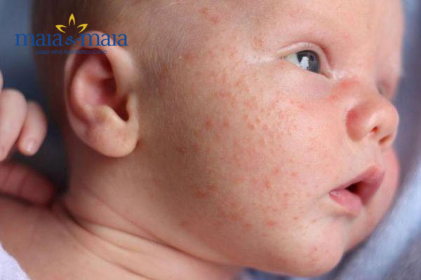 Mụn trứng cá ở trẻ sơ sinh Mụn trứng cá ở trẻ sơ sinh