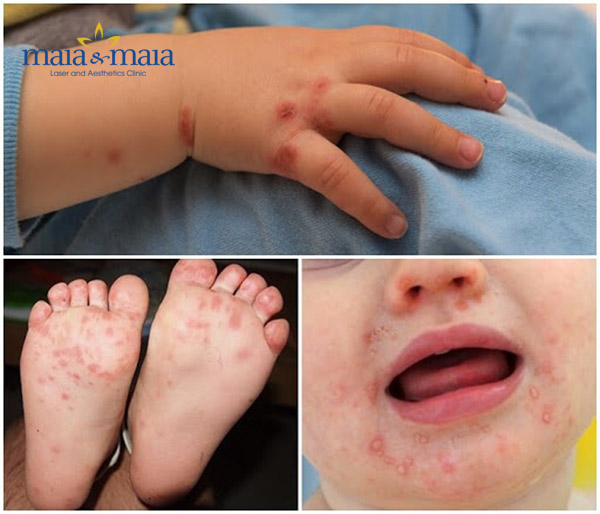 Bệnh tay chân miệng Bệnh tay chân miệng