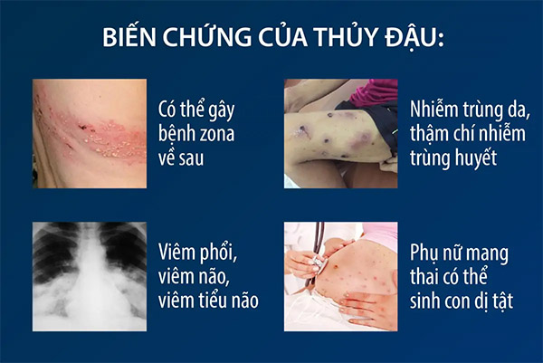 Biến chứng nguy hiểm của bệnh thủy đậu Biến chứng nguy hiểm của bệnh thủy đậu