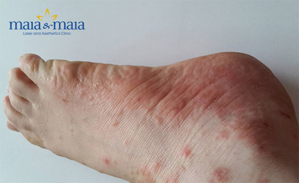 Bệnh tổ đỉa gây ngứa rát, khó chịu Bệnh tổ đỉa gây ngứa rát, khó chịu