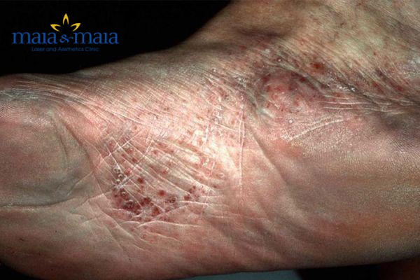 Hình ảnh bệnh tổ đỉa ở chân Hình ảnh bệnh tổ đỉa ở chân